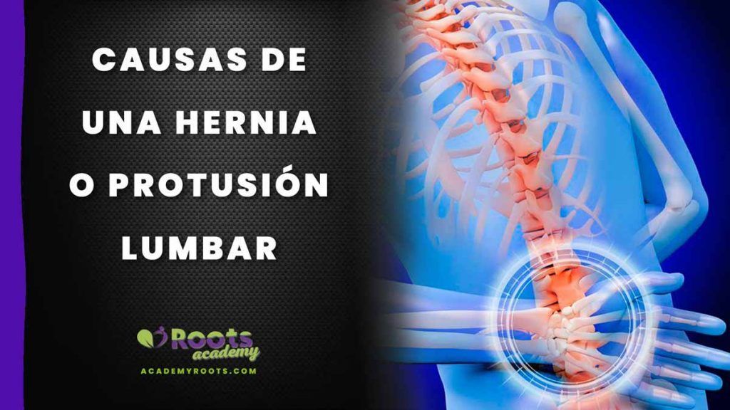 Roots HERNIA-LUMBAR