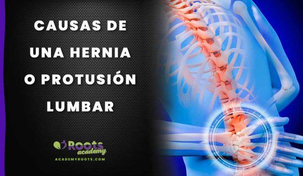 Roots HERNIA-LUMBAR